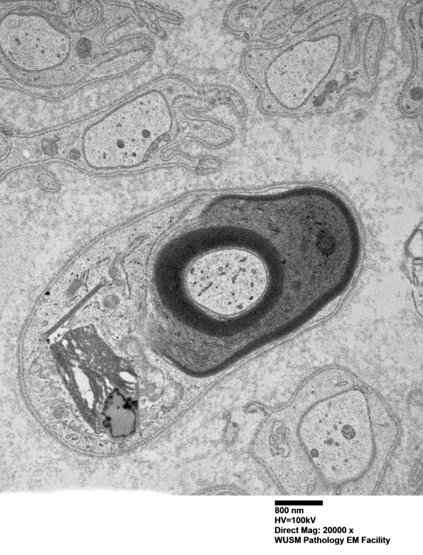 1B6A (Case 1) Sural_061 - Copy