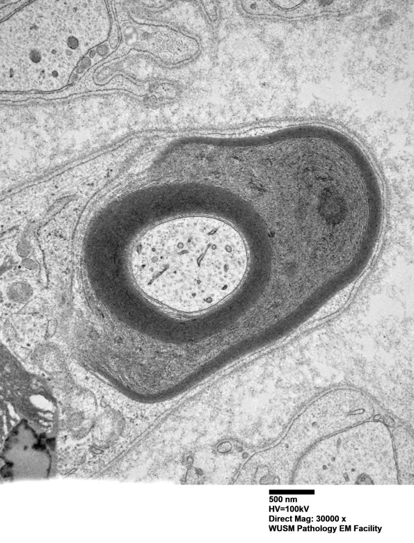 1B6B (Case 1) Sural_062 - Copy