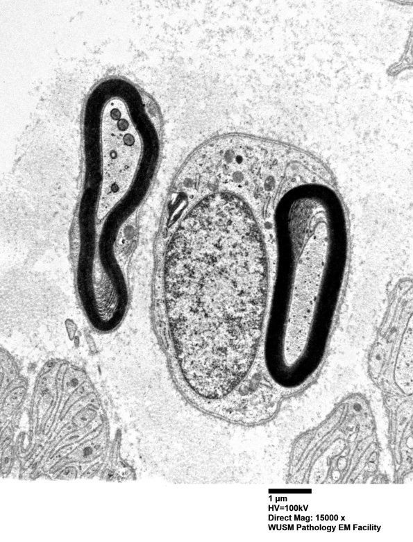 1C2A (Case 1) Sural_014 - Copy