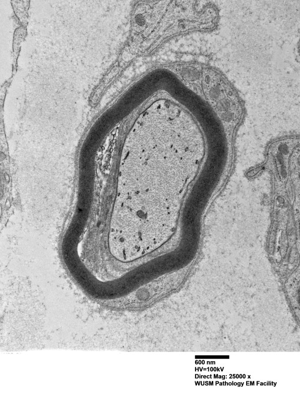1C3A (Case 1) Sural_051 - Copy