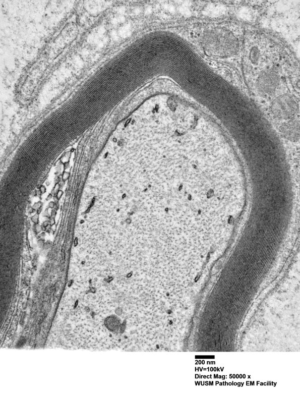 1C3B (Case 1) Sural_052 - Copy
