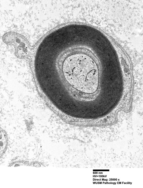 1C4 (Case 1) Sural_057 - Copy