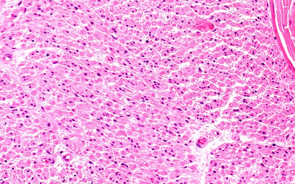 2A2 POEMS (Case 2) 40X 2