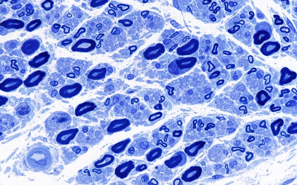 2B2 POEMS (Case 2) Plastic 100X 4