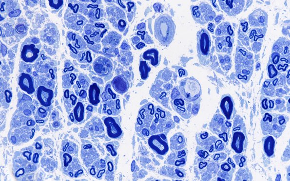 2B3 POEMS (Case 2) Plastic 100X 3