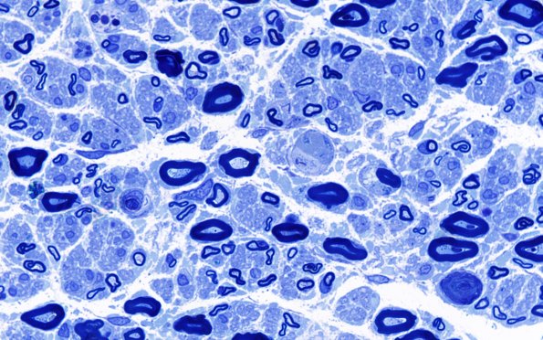 2B4 POEMS (Case 2) Plastic 100X 7