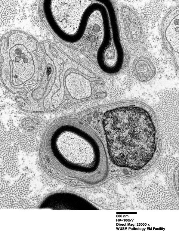 2C1A POEMS (Case 2) EM 022 - Copy