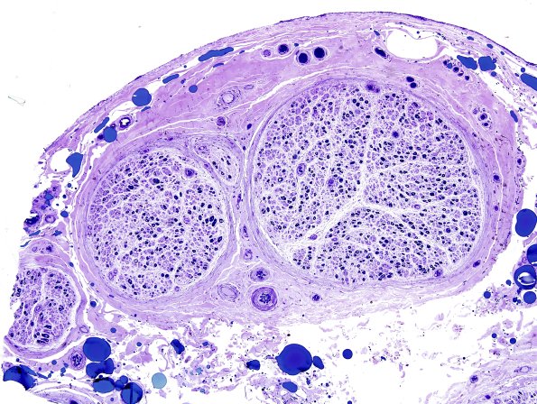 4A1 POEMS (Case 4) Plastic 5.jpg