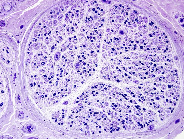 4A2 POEMS (Case 4) Plastic 4.jpg