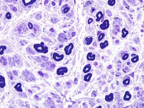 4A3 POEMS (Case 4) Plastic 100X 2.jpg