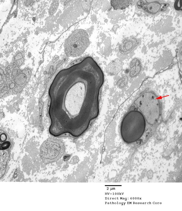 4C1A POEMS vs S-L Cleft (Case 4) 001 copy - Copy