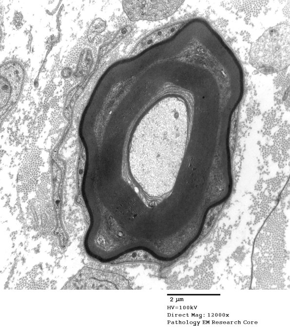 4C1B POEMS vs S-L Cleft (Case 4) 002 - Copy