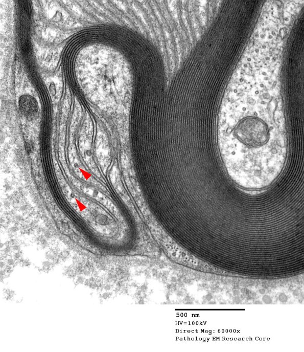 4C2C POEMS vs S-L Cleft (Case 4) 014 copy.jpg