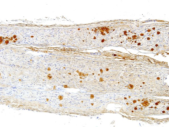 10B1 Amyloid NP (Case 10) Anti-transthyretin 1
