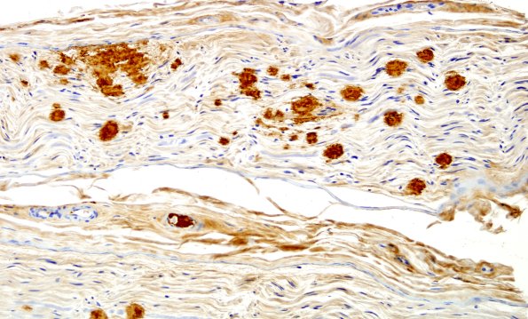 10B2 Amyloid NP (Case 10) Anti-transthyretin 5