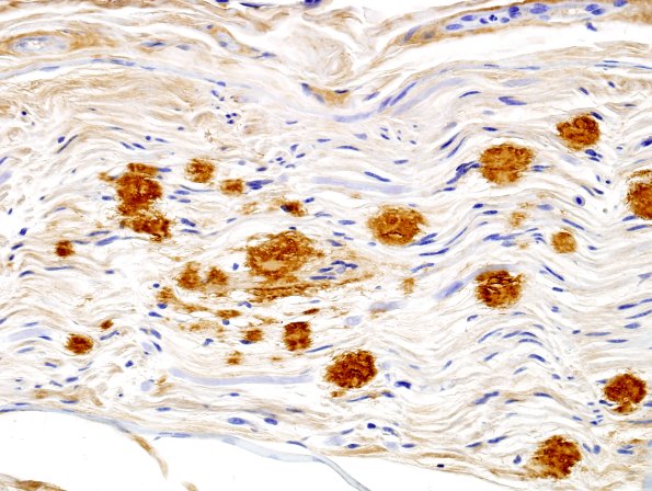 10B3 Amyloid NP (Case 10) Anti-transthyretin 6