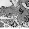 12A1 Amyloid Nephropathology (Case 12) EM 004 - Copy