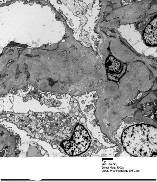 12A1 Amyloid Nephropathology (Case 12) EM 004 - Copy