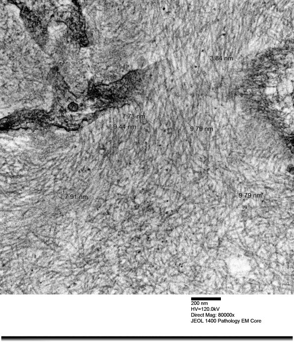12A2 Amyloid Nephropathology (Case 12) EM 009 - Copy
