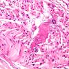 13A2 Amyloid Neuropathy H&E (Case 13) 40X 1
