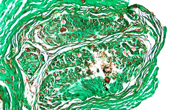 13B1 Amyloid Neuropathy TRI (Case 13) 20X 1