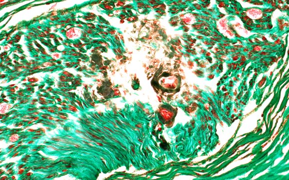 13B2 Amyloid Neuropathy TRI (Case 13) 40X 1