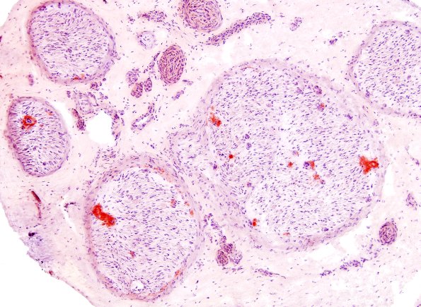 13C2 Amyloid (Case 13) Congo Red 3