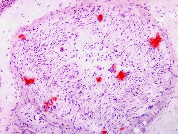 13C3 Amyloid (Case 13 Congo Red 7C
