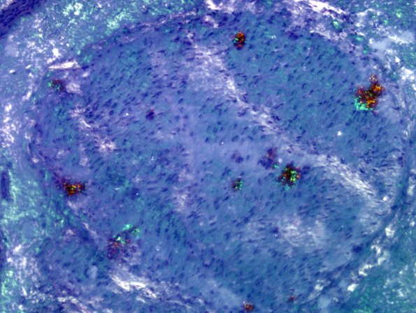 13C4 Amyloid (Case 13) Congo Red 7A