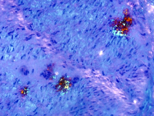 13C6 Amyloid (Case 13) Congo Red 6C