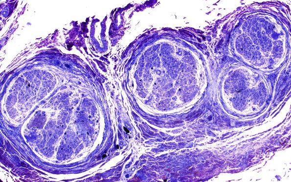 13D1 Amyloid Neuropathy (Case 13) Plastic 10X 1