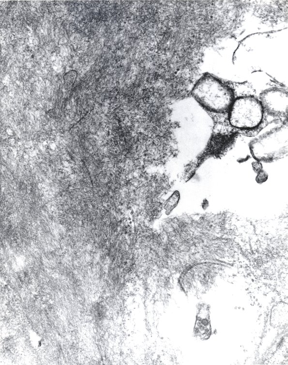 13E3 Amyloid Neuropathy (Case 13) 43K EM - Copy