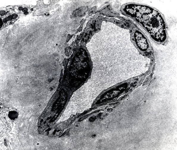 13E5 Amyloid Neuropathy (Case 13) EM - CopyB