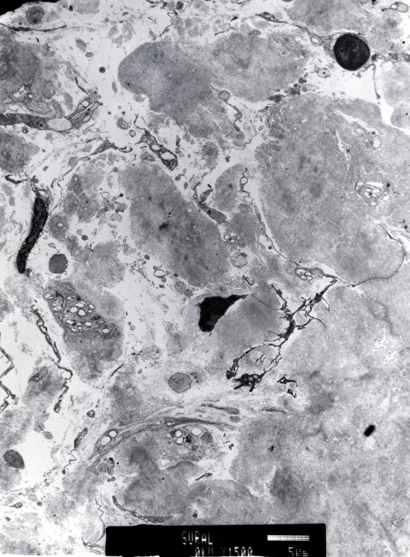 13E6 Amyloid Neuropathy (Case 13) EM 1500X - Copy