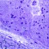14C-Amyloid-neuropathy-Case-14-Plastic-section-2.jpg
