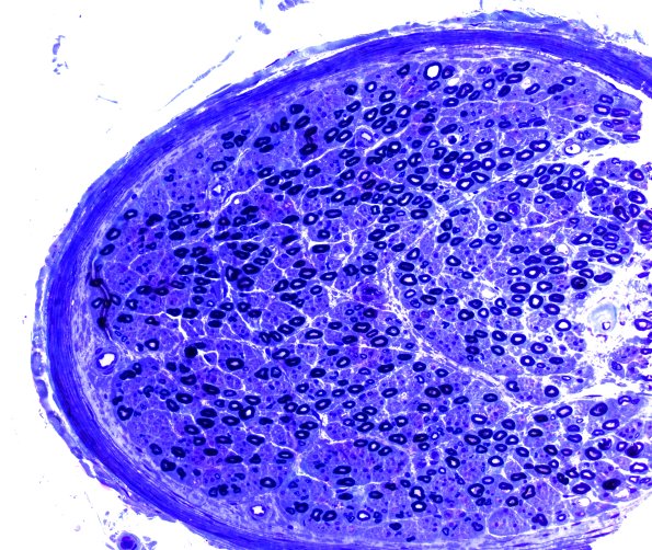 16A1 Amyloid neuropathy (Case 16) Plastic 20X