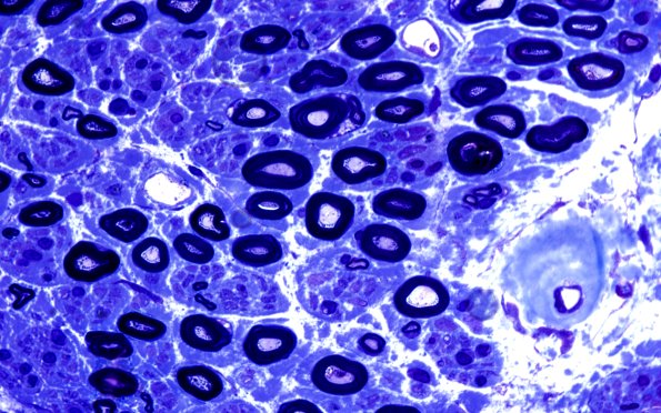 16A2 Amyloid neuropathy (Case 16) Plastic 100X 1