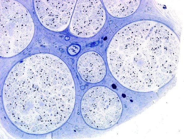 18A1 Amyloid NP (Case 18) Plastic 19