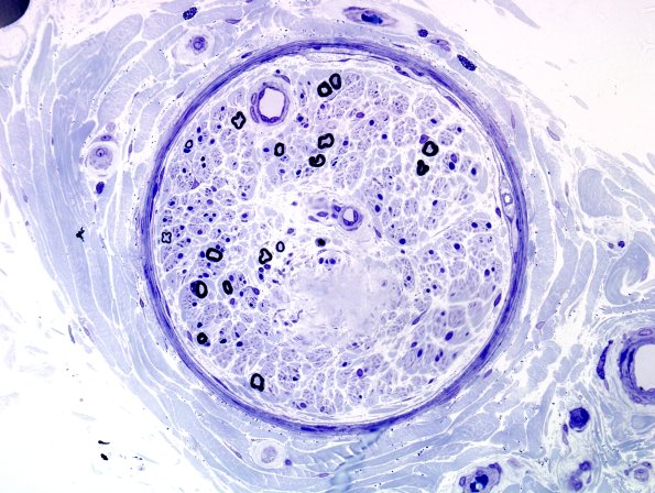 18A2 Amyloid NP (Case 18) Plastic 7