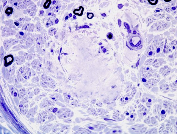 18A3 Amyloid NP (Case 18) Plastic 4A