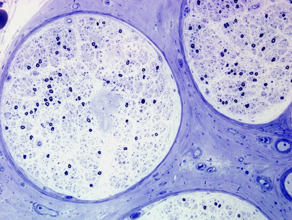 18A4 Amyloid NP (Case 18) Plastic 15