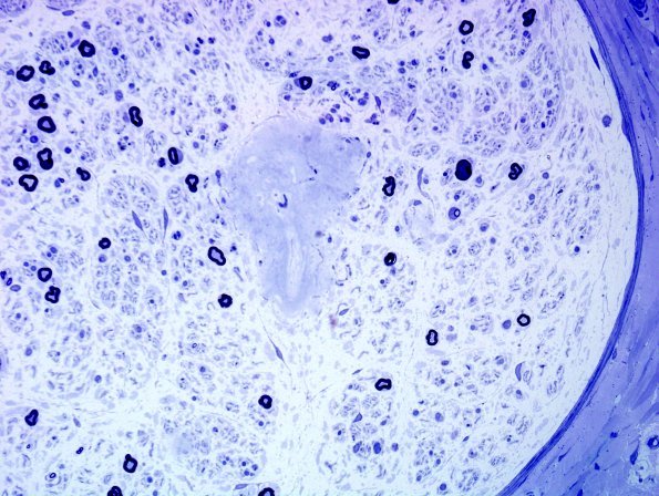 18A5 Amyloid NP (Case 18) Plastic 16