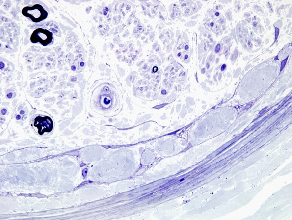 18A6 Amyloid NP (Case 18) Plastic 9