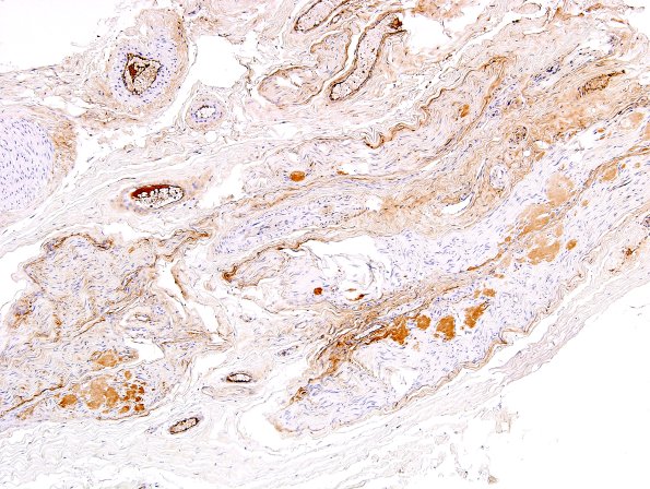 19A1 Amyloid NP (Case 19) Anti-Kappa 1
