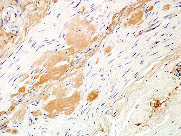 19A2 Amyloid NP (Case 19) Anti-Kappa 4