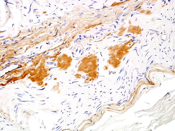 19A3 Amyloid NP (Case 19) Anti-Kappa 3