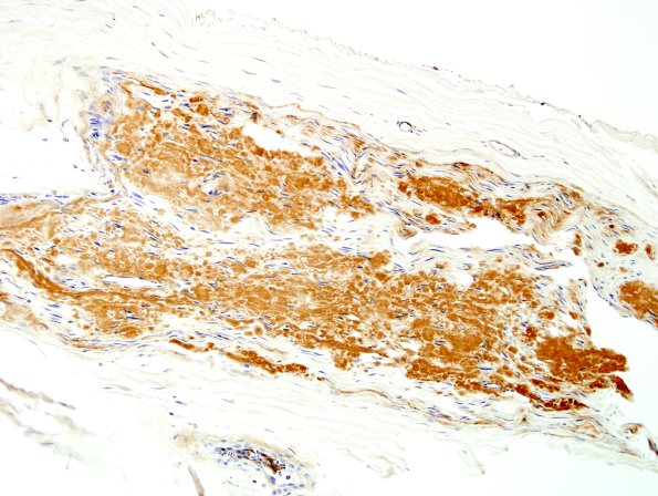 19A4 Amyloid NP (Case 19) Anti-Kappa 7