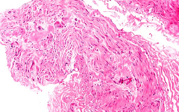 1A1 Amyloid (Case 1) H&E 20X 2