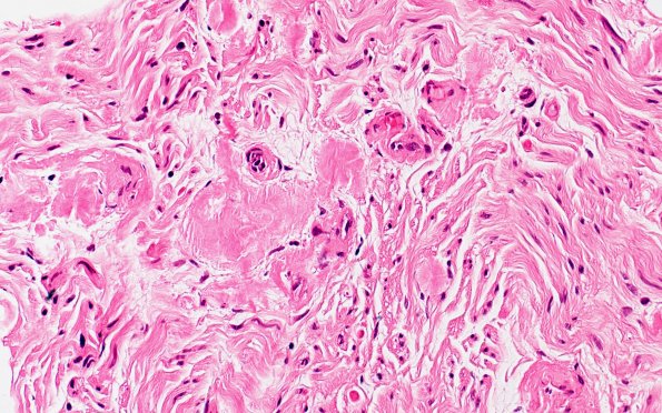 1A2 Amyloid (Case 1) H&E 20X 1