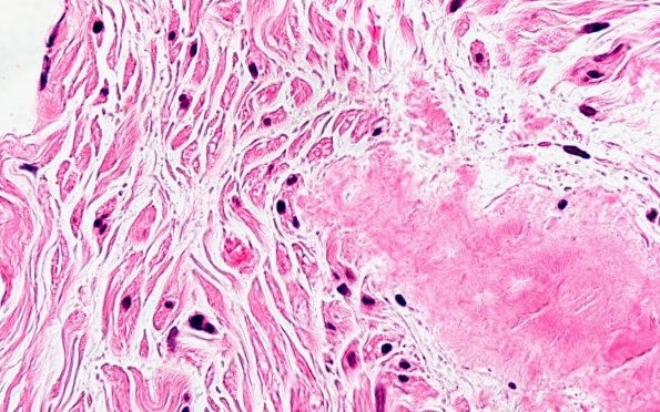 1A3 Amyloid (Case 1) H&E 100X 5